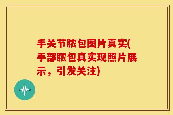 手关节脓包图片真实(手部脓包真实现照片展示,引发关注) 手关节脓包图片真实(手部脓包真实现照片展示,引发关注)