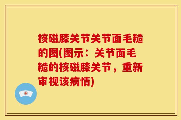 核磁膝关节关节面毛糙的图(图示：关节面毛糙的核磁膝关节，重新审视该病情)